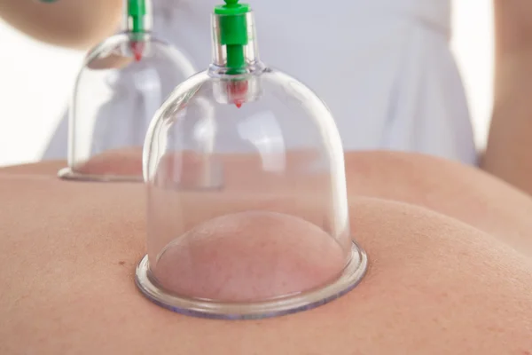 Primo piano del terapeuta che posiziona la tazza sulla schiena paziente femminile — Foto Stock