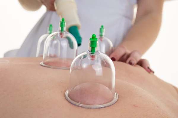 メスの患者の背中にカップを配置する鍼治療セラピスト — ストック写真