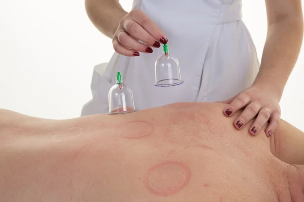 Acupuncture Therapist Placing Cup On The Back Of A Female Patient — Stock Photo, Image