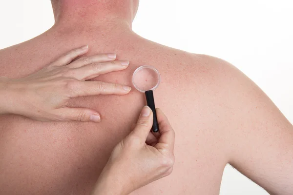 Medico esaminando la pelle pigmentata sulla schiena dell'uomo — Foto Stock