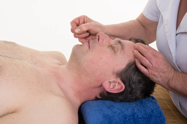 Detail van een man die zijn ontvangen van een acupunctuur-naald therapie — Stockfoto