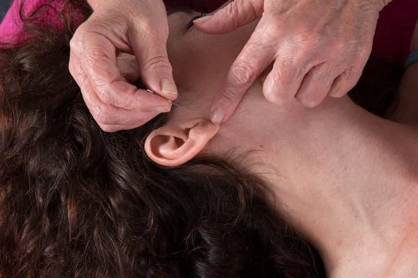 Detail akupunkturní jehly na ucho. — Stock fotografie