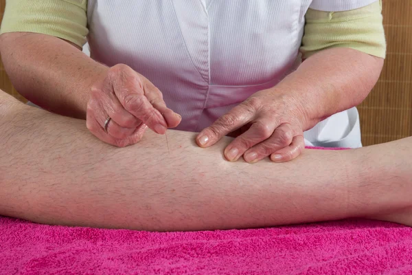 Mujer acupunturista se prepara para golpear la aguja —  Fotos de Stock