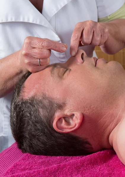 Acupuncturist prepares to tap needle around face  of man — Stock Photo, Image