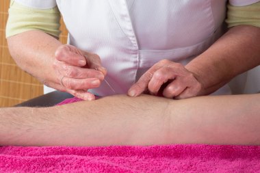 Akupunktur uzmanı iğne hastaların deri içine dokunun hazırlar