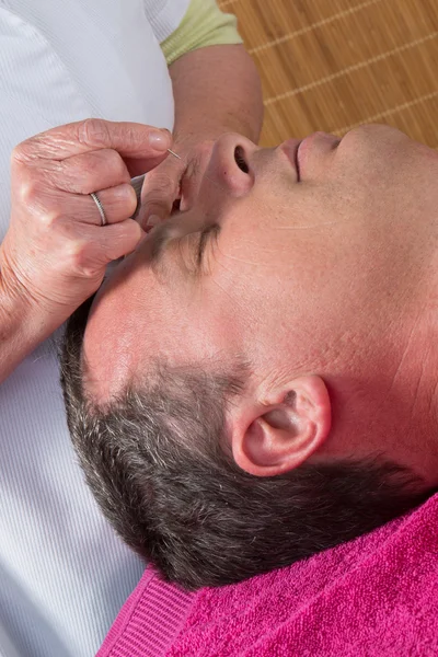 Akupunkteur bereitet sich darauf vor, Nadel im Gesicht des Mannes anzuzapfen — Stockfoto