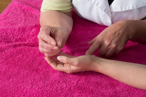 Detail of acupuncturist placing a needle in hand of the patient — Stock Photo, Image