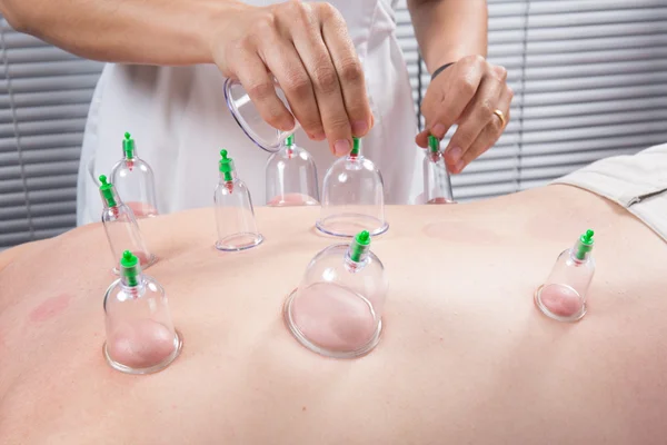 Détail d'un thérapeute en acupuncture enlevant un globe en plastique dans une procédure de tasse Photos De Stock Libres De Droits