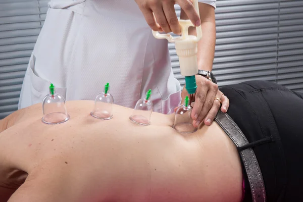 Acupunctura Foc cupping detaliu pe spatele omului — Fotografie, imagine de stoc