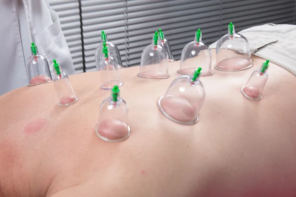 Acupunctura Foc cupping detaliu pe spatele omului — Fotografie, imagine de stoc