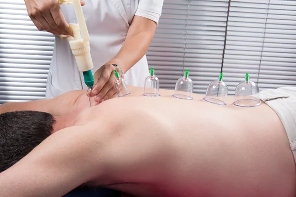 Acupuncture Fire cupping detail on man's back — Stock Photo, Image