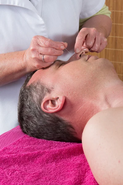 Detail van acupuncturist plaatsen een naald — Stockfoto