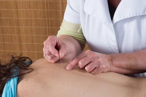 Lekarz wprowadzenie igły do akupunktury na ramieniu kobiety, szczelnie-do góry — Zdjęcie stockowe