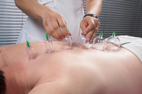 Cupping therapy, — Stock Photo, Image
