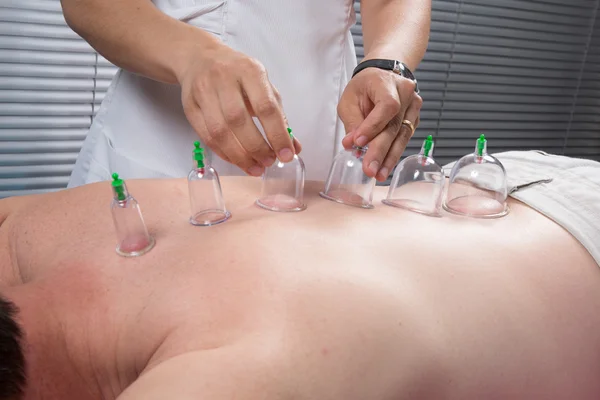 Terapia Cupping, — Zdjęcie stockowe