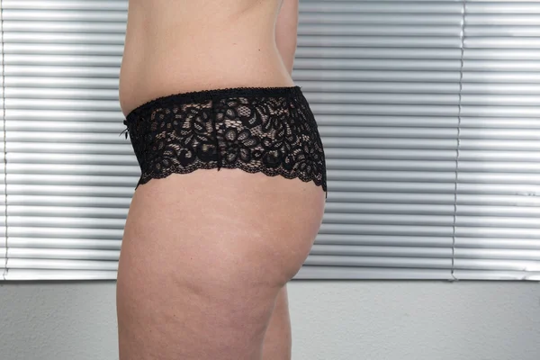 Kontrolle von Cellulite, weiblicher Hüfte, Nahaufnahme des weiblichen Körpers — Stockfoto
