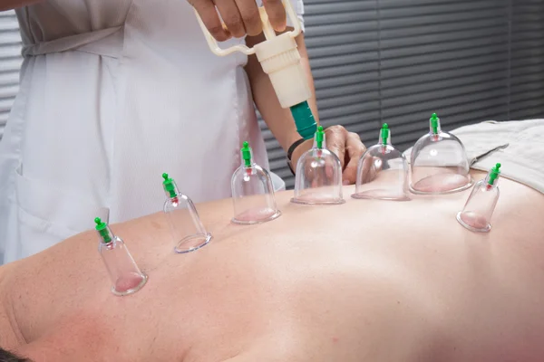 Terapia Cupping — Zdjęcie stockowe