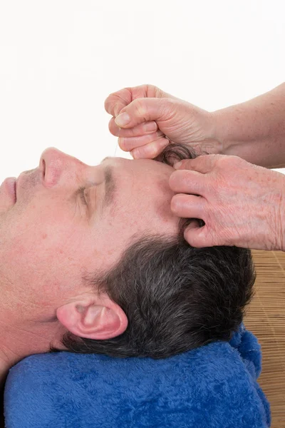 Close-up of man undergoing acupuncture treatment at Spa — Stock Photo, Image