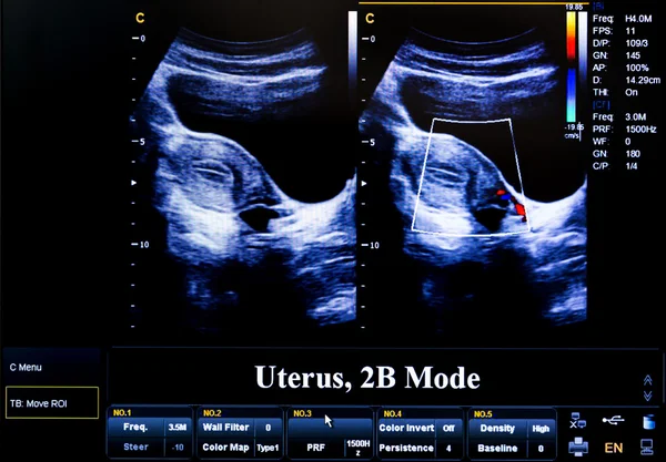 Imagen colorida del monitor de ultrasonido. Útero 2D — Foto de Stock