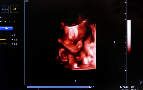 Imagen colorida del monitor de ultrasonido. Cara Fetral, Virtual HD — Foto de Stock