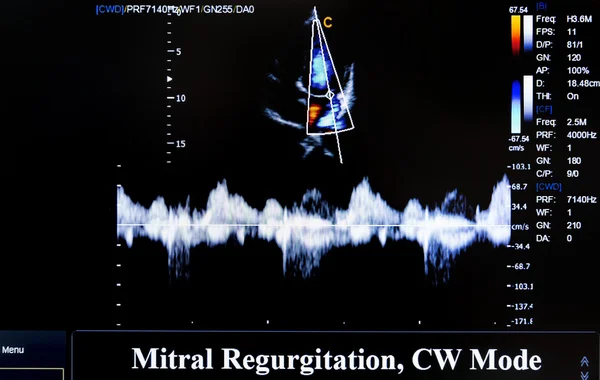 Immagine colorata del monitor a ultrasuoni. Rigurgito mitrale — Foto Stock
