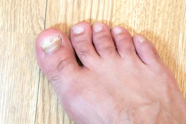 Fungus Infection on Nails of Man\'s Foot.