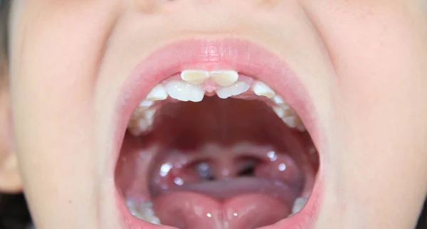 Seven year old girl with shark teeth