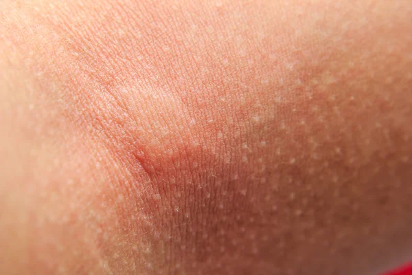 Primer plano de picaduras de mosquitos en el brazo — Foto de Stock