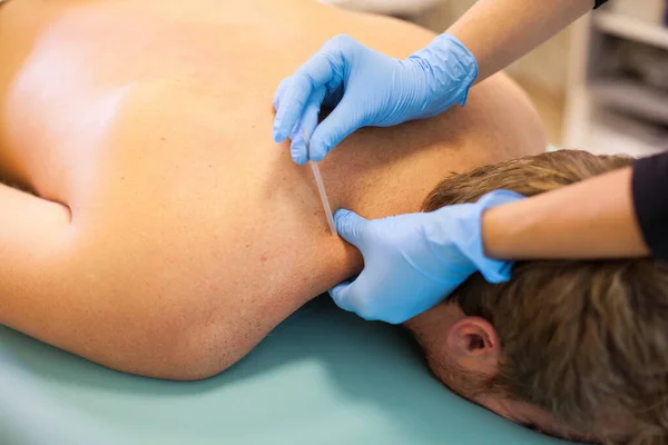 Doctor sticks needle into man\'s body on the acupuncture