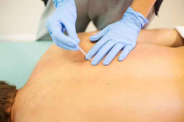 Doctor sticks needle into man\'s body on the acupuncture