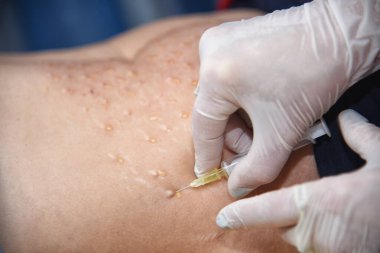 Plazma kaldırıcı. Yenilenme için enjeksiyonlar ve insan plazmasından deri kusması. Modern bir güzellik tedavisi.