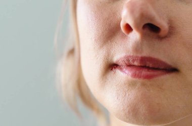 Dudağında uçuk var. Seçici odaklanma. İnsanlar.