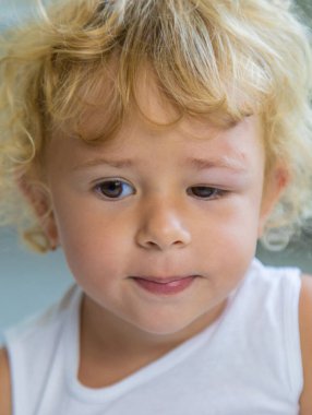 Çocuk gözü şişmiş durumda. Seçici odaklanma. Çocuk.