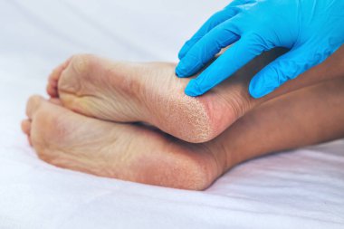 Dişi ayaklar topuklarda kuru deri. Seçici odaklanma. İnsanlar.