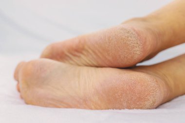 Dişi ayaklar topuklarda kuru deri. Seçici odaklanma. İnsanlar.