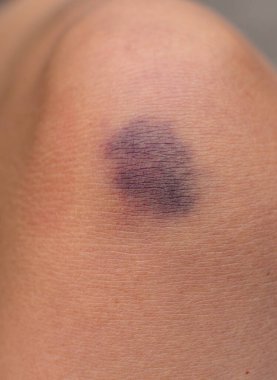 Kadın bacağında çürük var. Seçici odaklanma. insanlar.