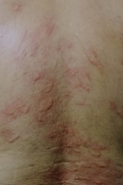 Шкіра алергії — стокове фото