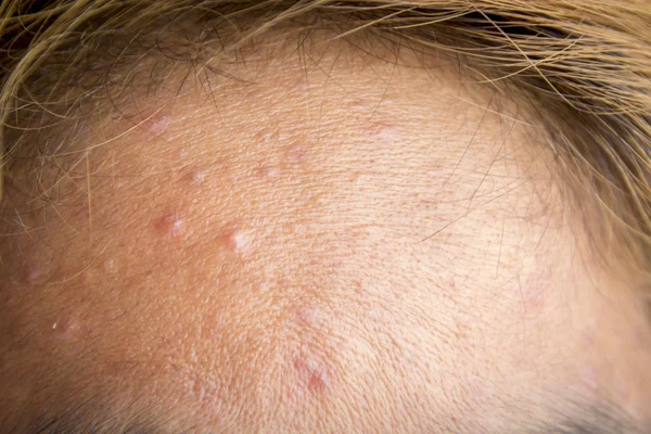 Forehead with typical problem with acne — Stock Photo, Image