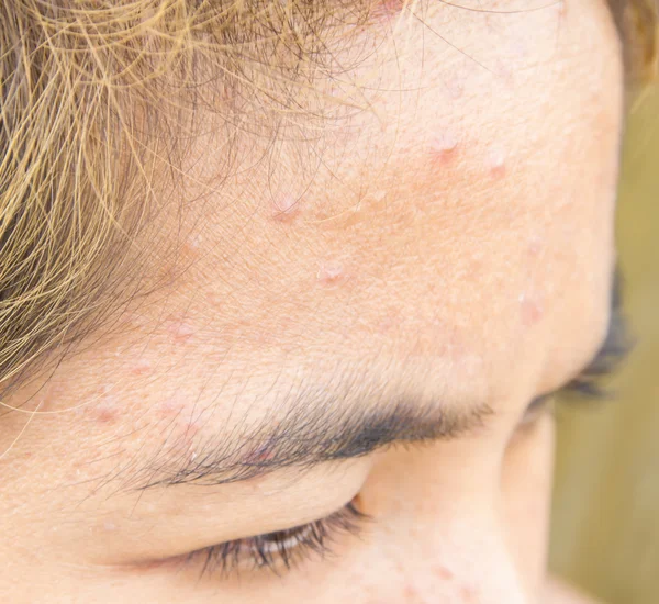 Frente con problema típico con el acné — Foto de Stock