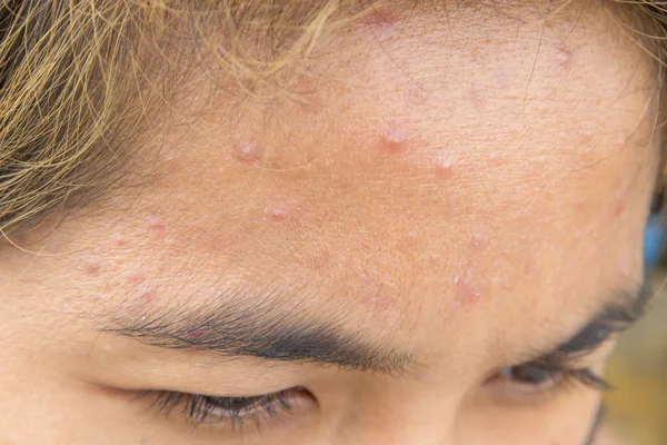 Forehead with typical problem with acne — Stock Photo, Image