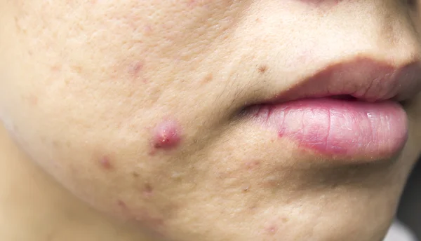 Cicatrizes da acne — Fotografia de Stock