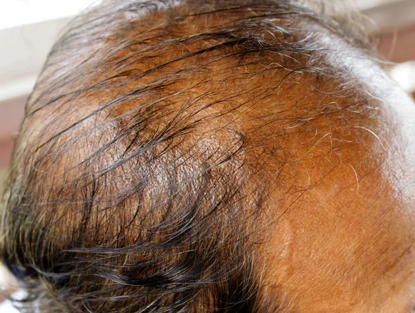 Perda de cabelo — Fotografia de Stock