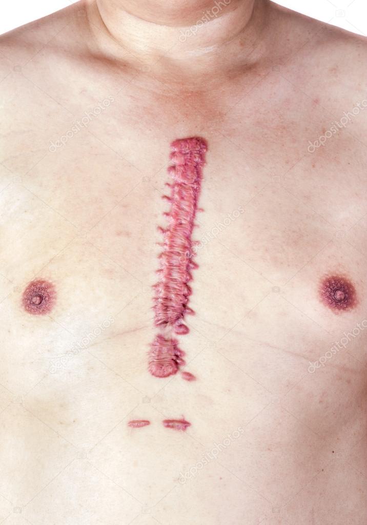 The hypertrophic scar or swell cicatrix is big and long, convex and large. On the chest, the skin is pink and red. Occurs after surgery. Aortic dissection type A by opening the chest.