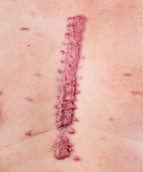 The hypertrophic big scar or swell cicatrix - closed up shot. — Stock Photo, Image