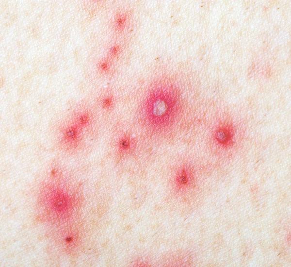 Herpes Zoster (telhas ) — Fotografia de Stock