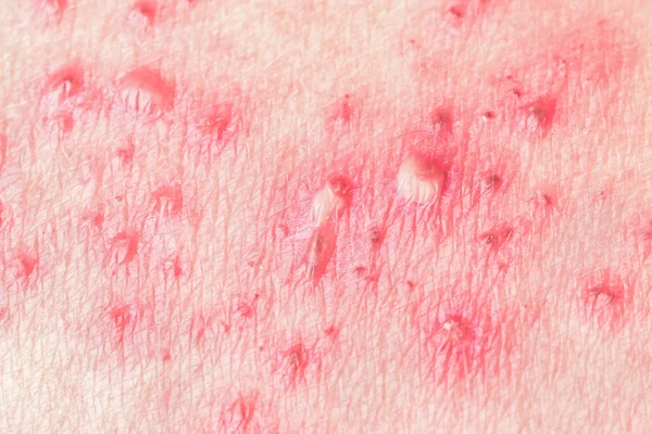 Herpes Zoster (Zona)