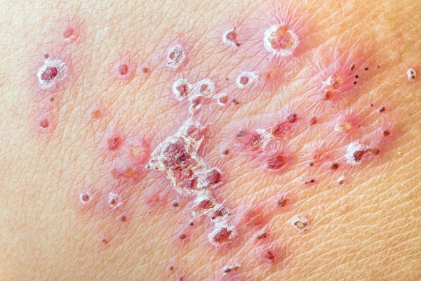 Herpes Zoster (Shingles) - after treatment