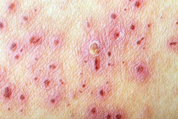 Herpes Zoster (Shingles) - after treatment