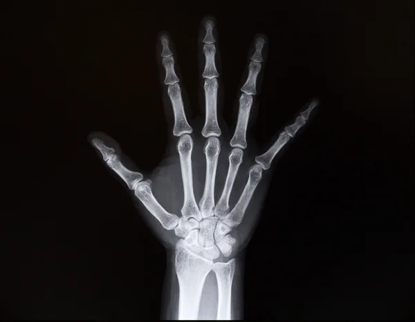 腕の手首の x 線写真。医学 — ストック写真