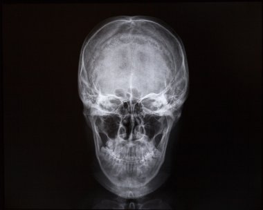 X-ışınları kafatası ve iç boşluğu. Tıp